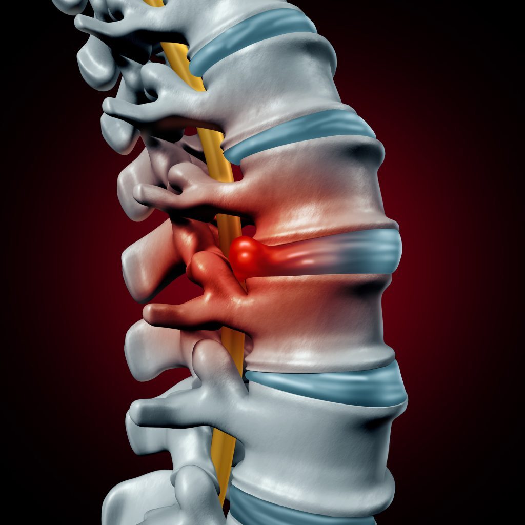 Disc Degeneration and Herniation