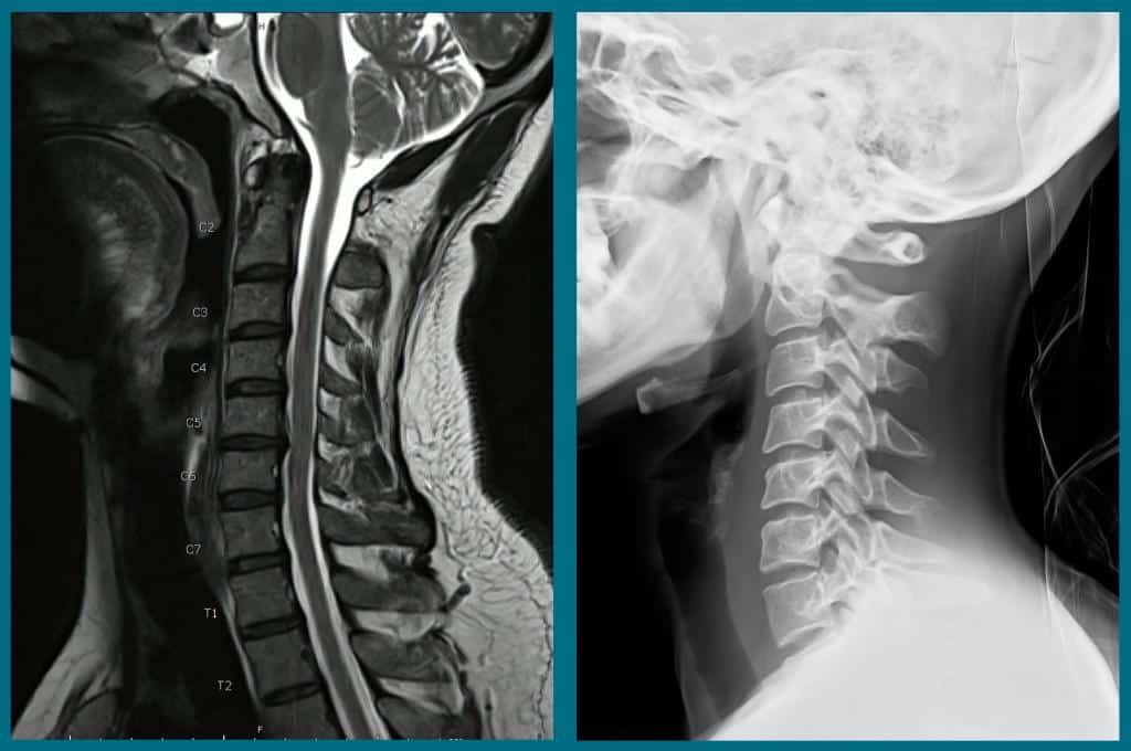 Neck MRI And XRay Health 1st Wellness & Physical Medicine